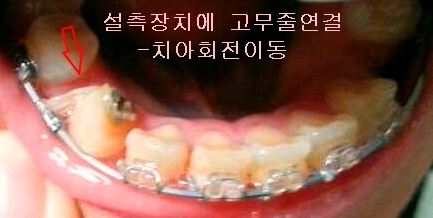 치아교정후기6-3.jpg