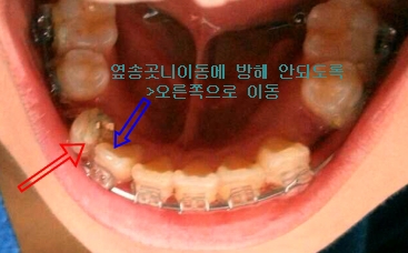 치아교정후기6-2.jpg