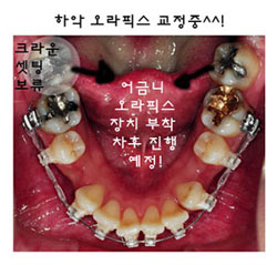치아교정후기3.jpg