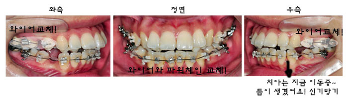 치아교정후기1.jpg