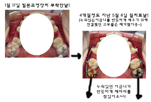 치아교정후기2.jpg
