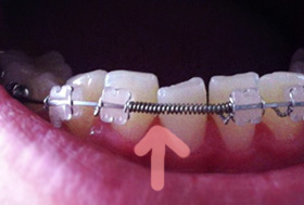 치아교정후기01.jpg