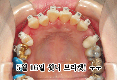 윗니브라켓0516.gif