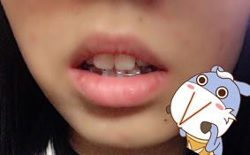 치아교정후기6.JPG