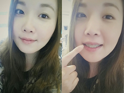 치아교정후기01.jpg