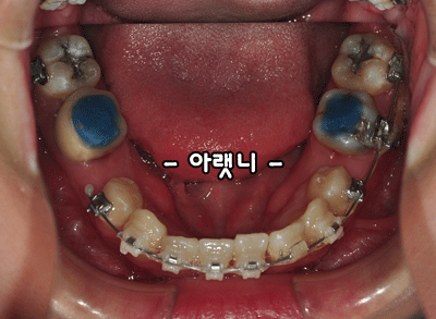 99아랫니.gif