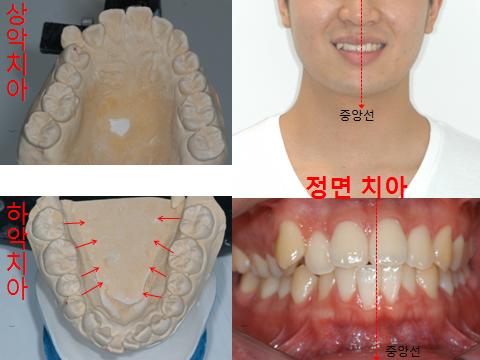 턱관절+교정후기2.png