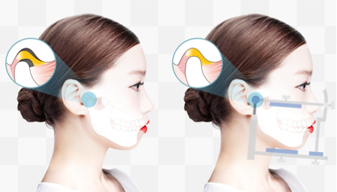 턱관절+교정후기6.png