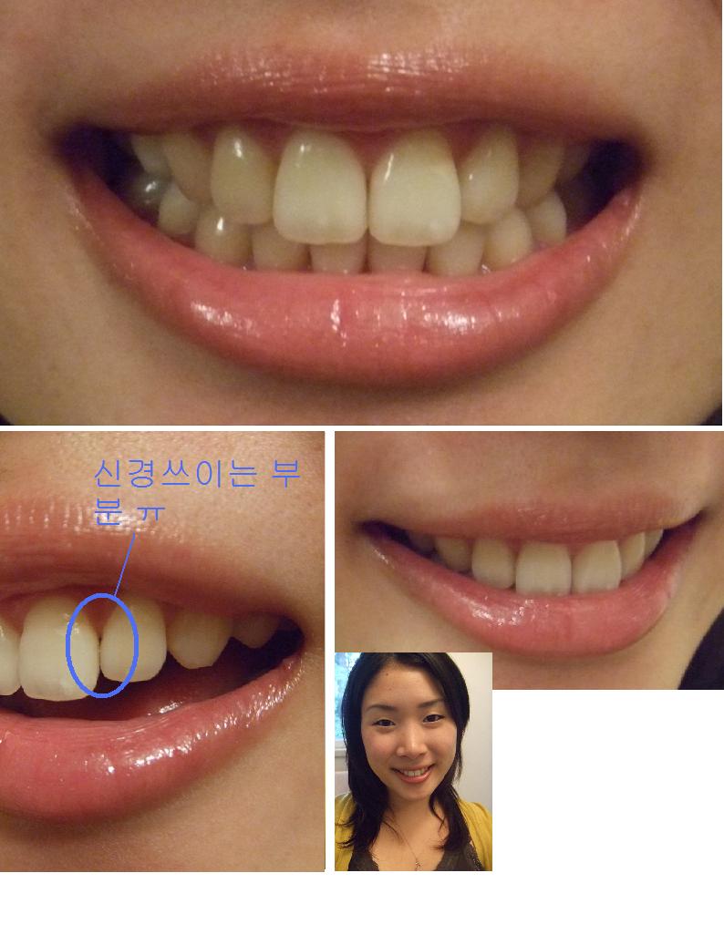 BracesOff.jpg
