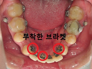 하악사진.jpg