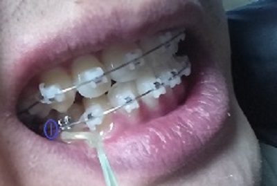 턱관절치아교정후기12화사진1.jpg