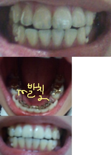 치아 사진 3개.jpg