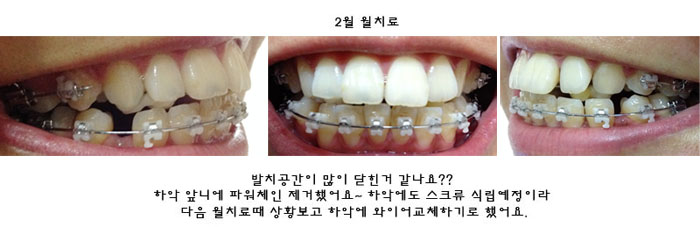 치아교정후기2.jpg