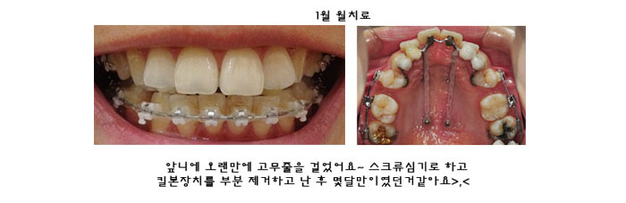 치아교정후기1.jpg