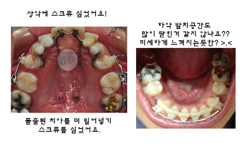 치아교정후기3.jpg