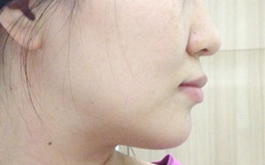 치아교정후기5.jpg
