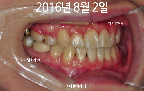 160802_right_ham(2).png