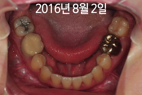 160802_lower_ham.png