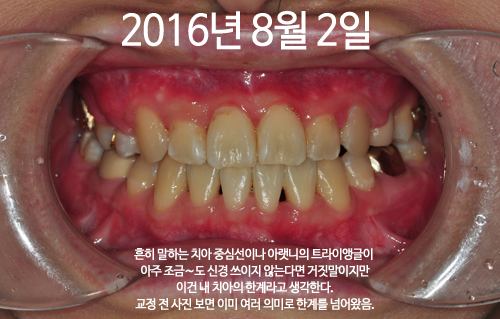 160802_str_ham(1).png