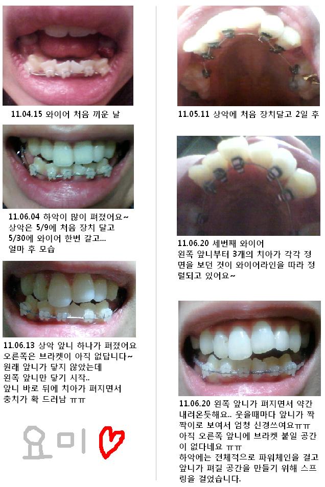 110620 치아변화.JPG