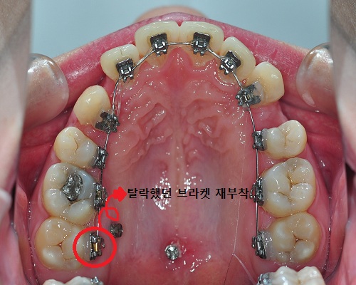 상악브라켓재부착.jpg