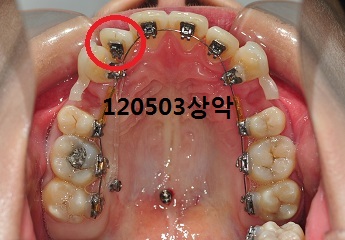 120503상악.jpg