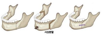 양악수술종류_주걱턱_1_1.JPG