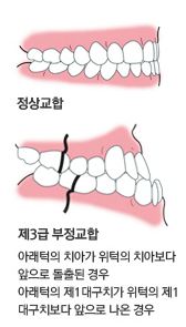 주걱턱_2.JPG