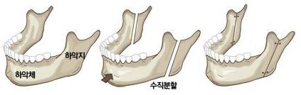 양악수술종류_주걱턱_1_2.JPG