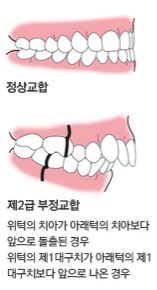 무턱_1.JPG