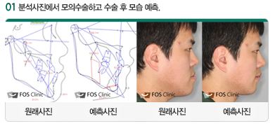 선수술과정_2.JPG