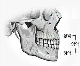 양악수술-1.JPG