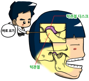 턱관절증상01.gif