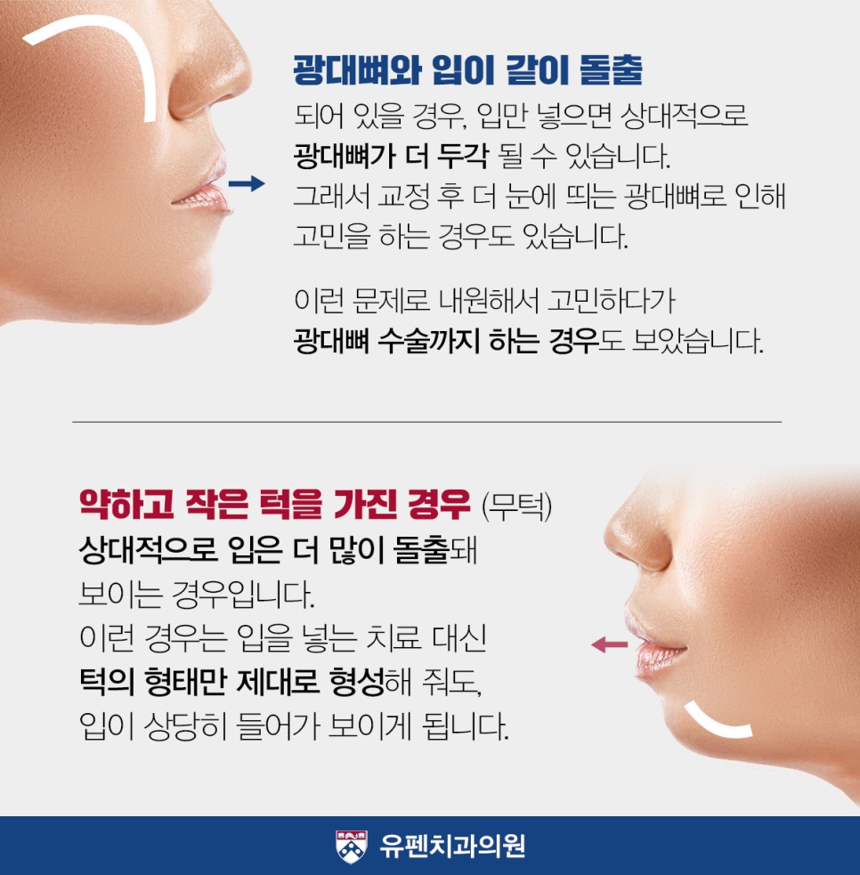 돌출입교정_이마광대턱2 (1).jpg