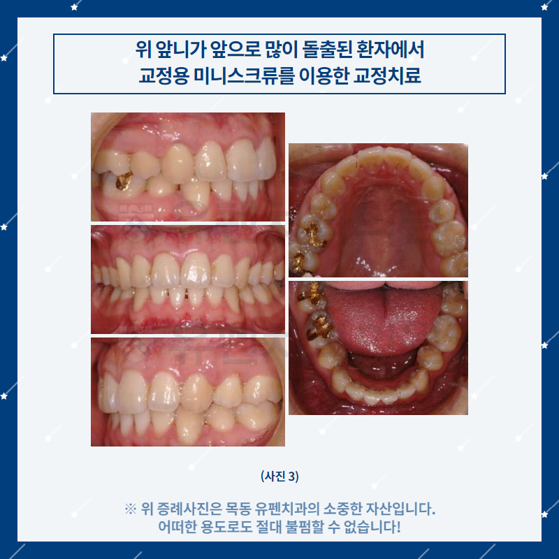 오목교교정치과_유펜치과_돌출된_위_앞니의_교정치료_04.png