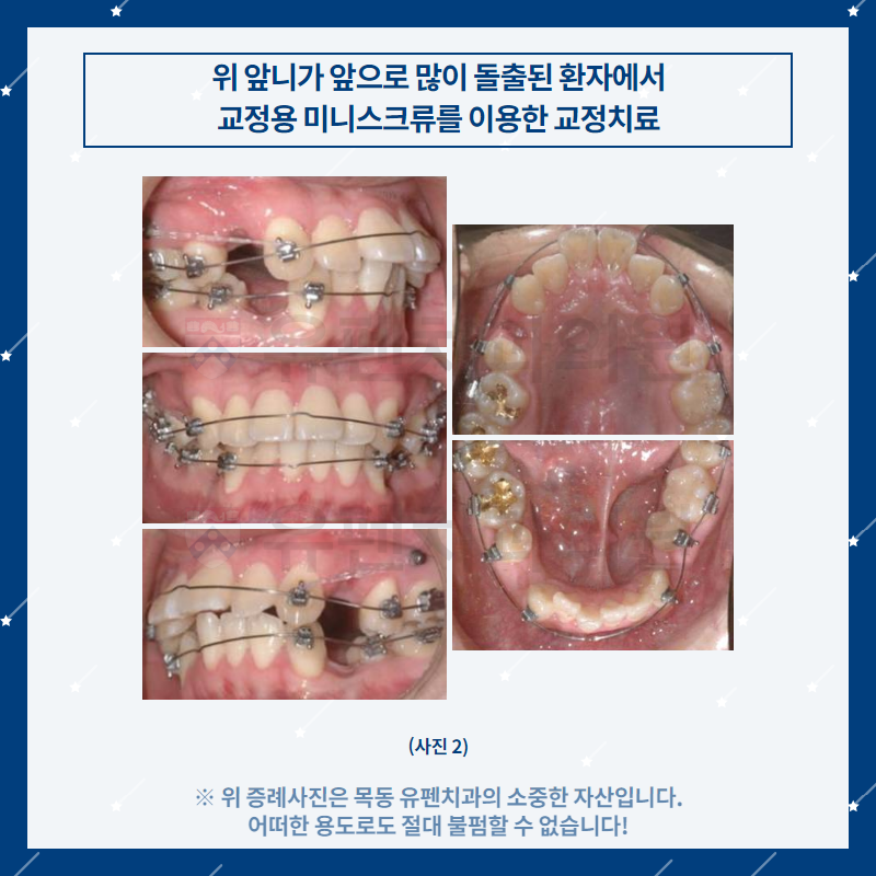 오목교교정치과_유펜치과_돌출된_위_앞니의_교정치료_03.png