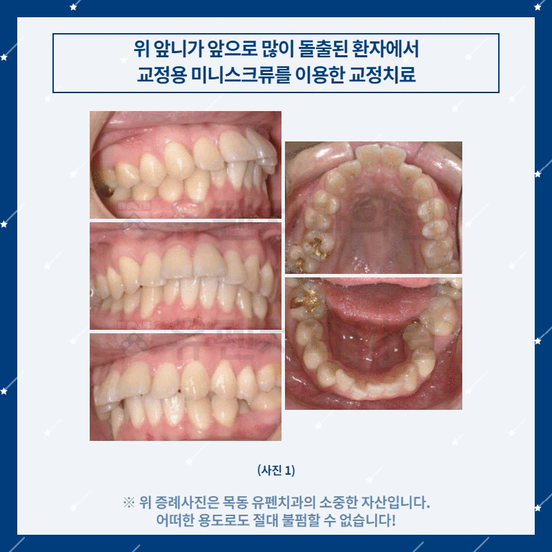 오목교교정치과_유펜치과_돌출된_위_앞니의_교정치료_07.gif