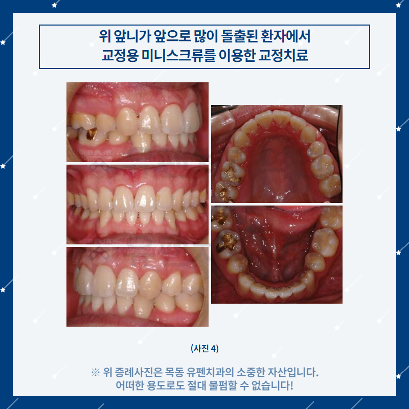 오목교교정치과_유펜치과_돌출된_위_앞니의_교정치료_05.png