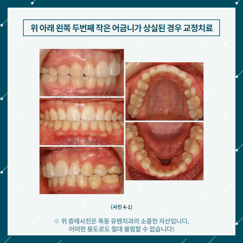 6목동유펜치과_위_아래_왼쪽_두_번째_작은_어금니가_상실된_경우의_.png