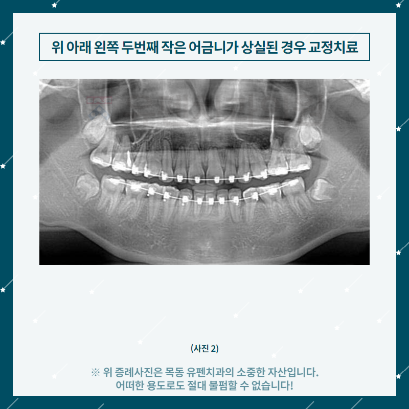 4목동유펜치과_위_아래_왼쪽_두_번째_작은_어금니가_상실된_경우의_.png