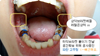 교정 62일째_어금니 파란고무링.jpg
