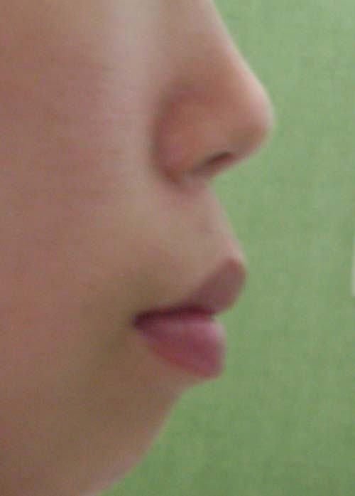 교정장착후 옆모습.jpg