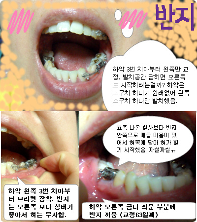 교정 63일째_하악 왼쪽 브라켓.jpg