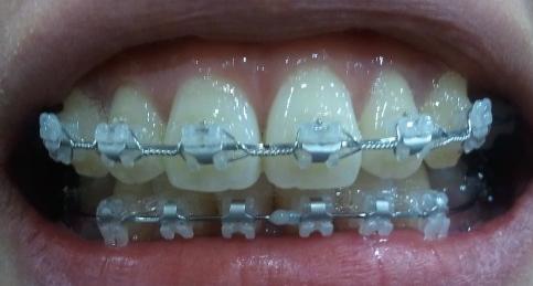 tooth.JPG