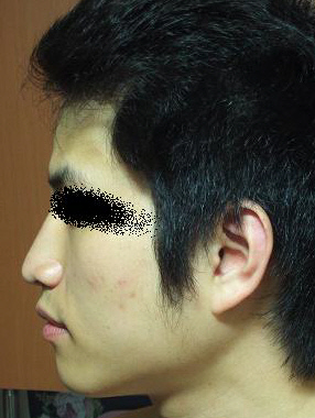 교정전측면2.JPG